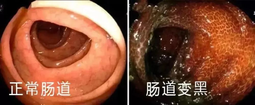 黑变病表现mc病变多数位于近端结肠,严重时可累及整个结肠,包括阑尾