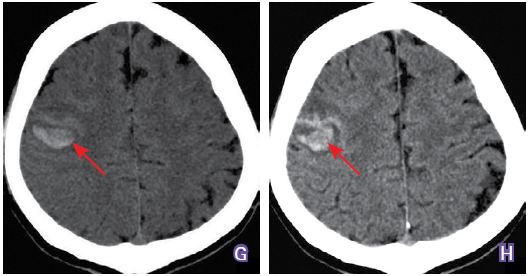 走错路正常细菌秒变恶魔丨卒中杂谈第9期
