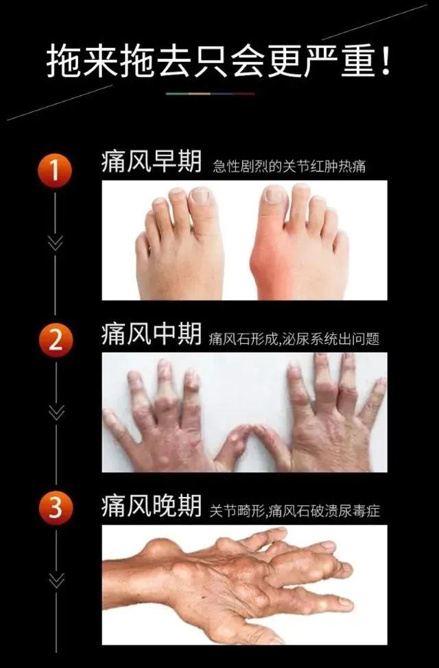 这几个步骤看完不后悔,控制痛风不再难!