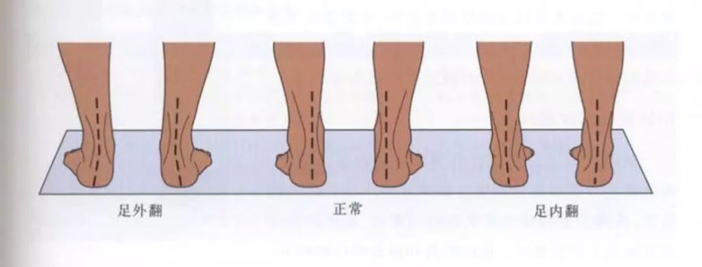 足內翻&足外翻脊柱側彎是一種比較嚴重的體態問題,不僅影響形體,容易