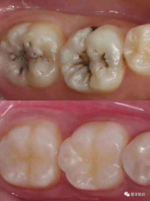 牙齿上的黑线是什么是蛀牙了吗