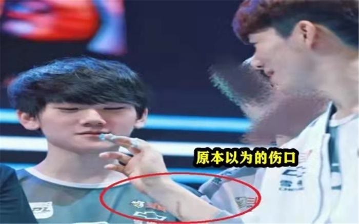 lol:theshy手伤被曝光 远比想象中严重下赛季是否继续打职业成疑_腾讯