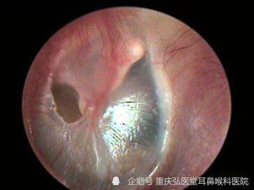 重庆弘医堂耳鼻喉医院分享鼓膜穿孔后会出现的主要症状