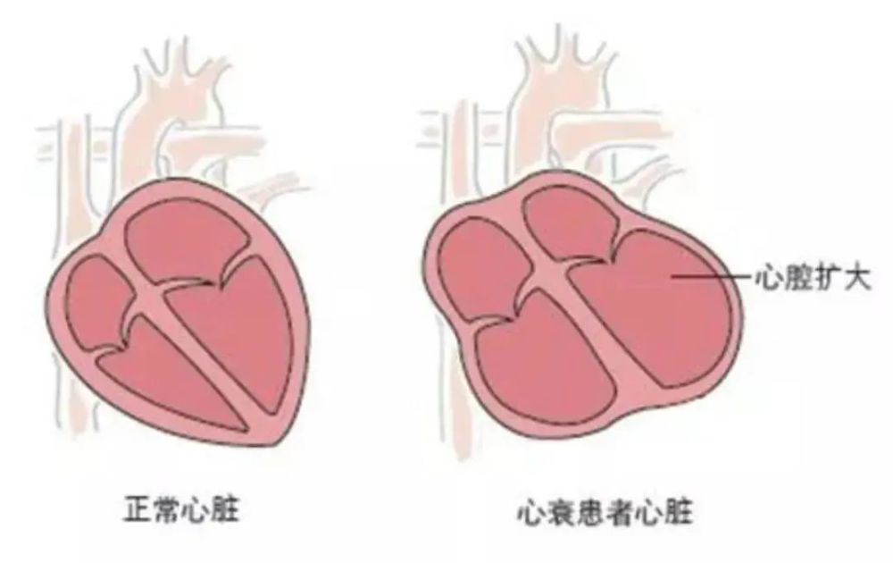 高血压是怎样一步一步伤害心脏的?