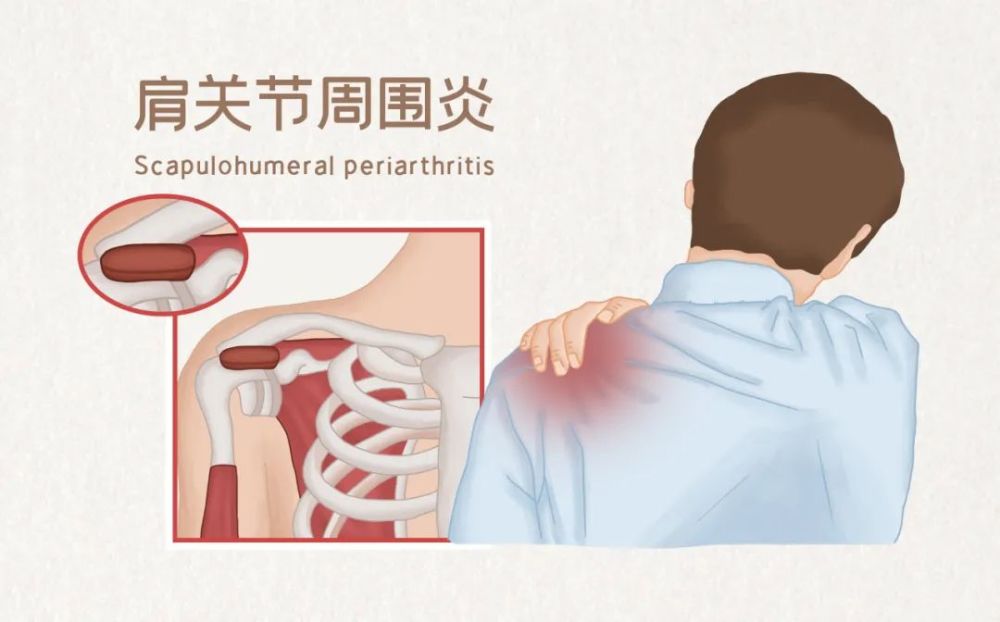 肩周炎康复常用的锻炼方法