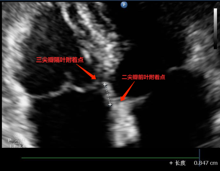 三尖瓣之前叶和后叶下移应该怎么看?_腾讯新闻