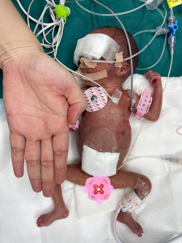 早产儿肠闭锁危在旦夕医院通过手术成功救治