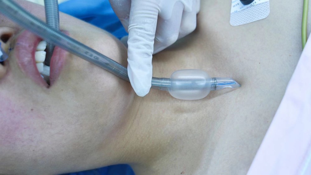 插管深浅一摸便知触摸套囊法用于判断插管深度