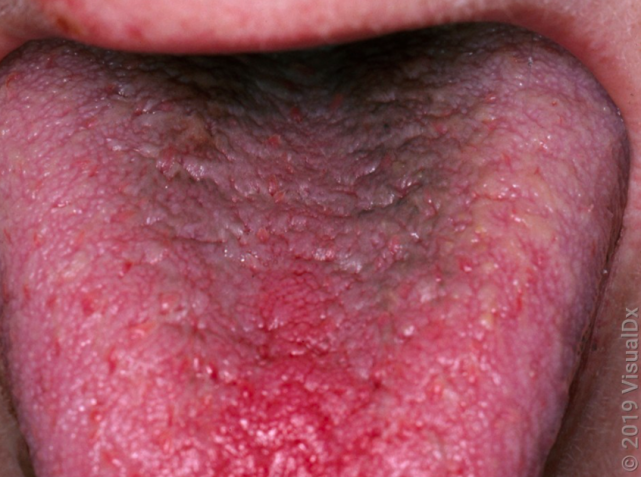 看看你是不是黑毛舌_腾讯新闻