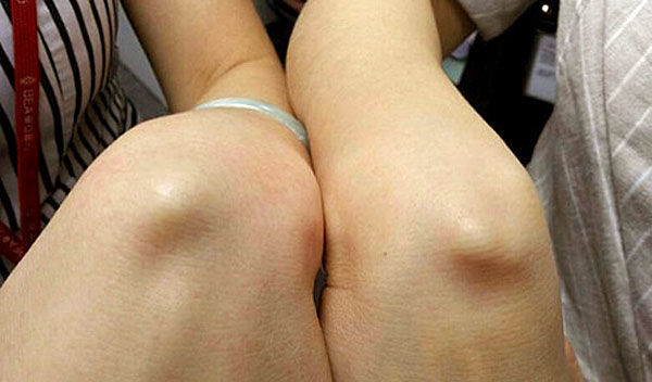 在20世纪初期,世界上只有11%的人膝盖中有豆骨,而到2018年这个比例就