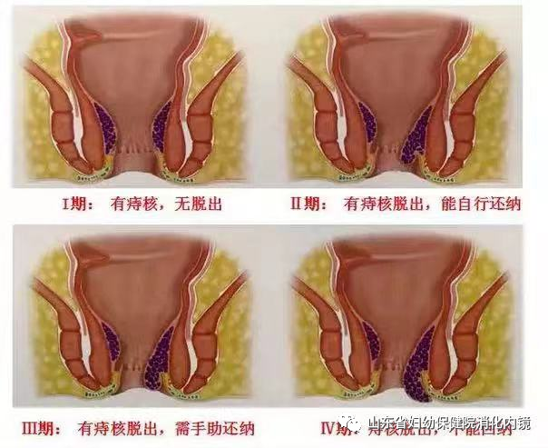 不开刀治痔疮内痔微创治疗新方法