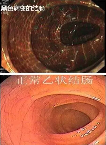 结肠黑变病(melanosis coli, mc)是以结肠黏膜色素沉着为特征的代谢