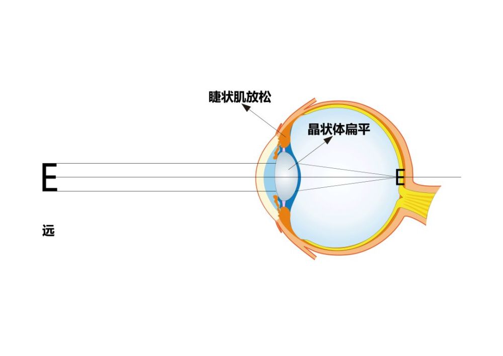 畏光,对光敏感;·眼胀,头疼;·视远模糊;调节过度的症状:调节过度