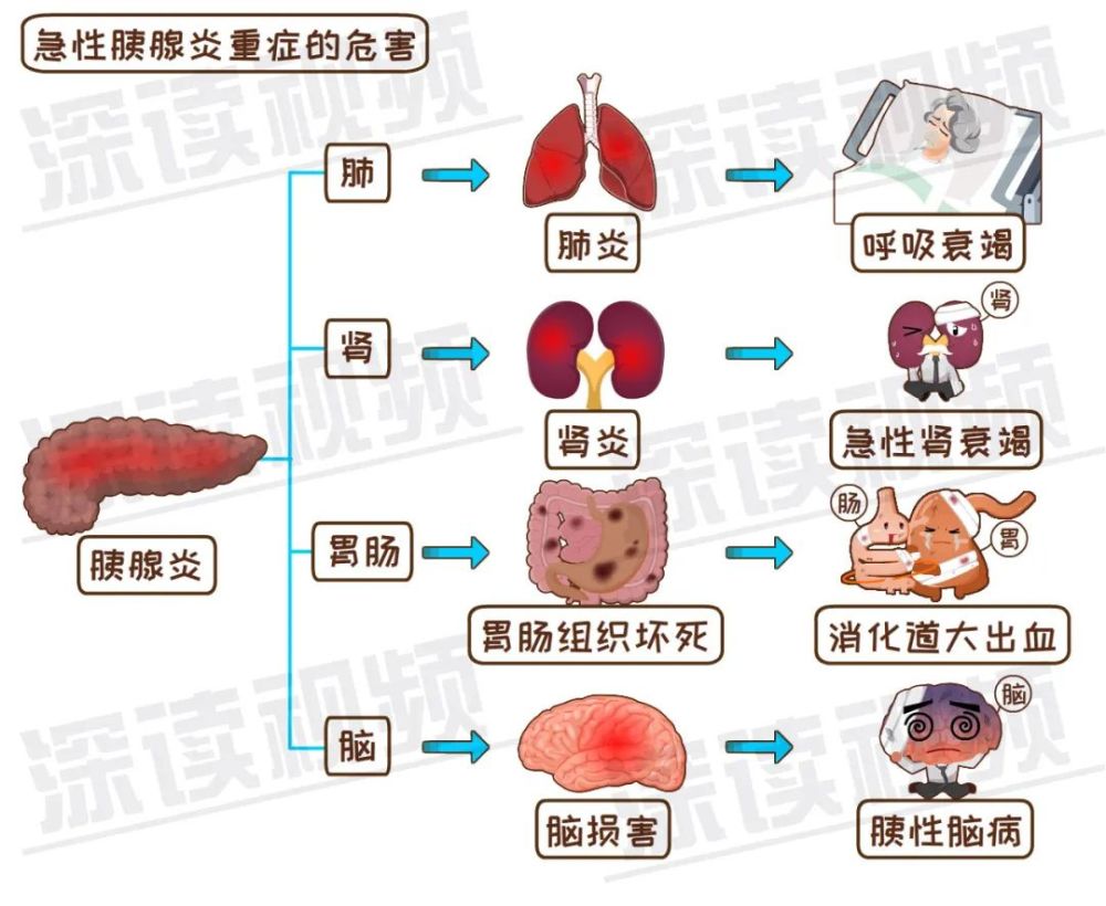 发作起来腹痛似刀绞,致死率高达10%,解密能要命的腹痛之胰腺炎_腾讯