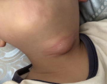 宝宝脖子有小孔当心是鳃瘘