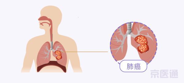 肺癌最明显的一个征兆图片（肺癌最明显的一个征兆）