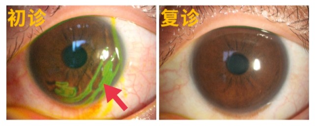 笔盖戳眼竟致角膜损伤,这些紧急处理方案请牢记