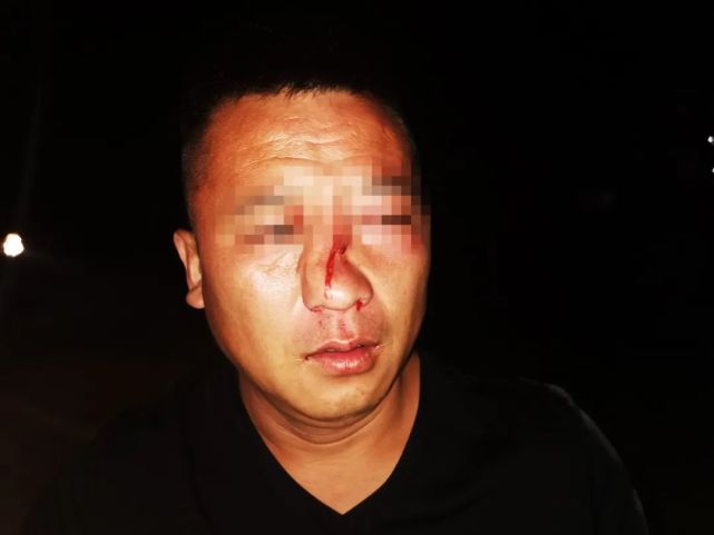 莒南男子酒后打了同事一拳,鼻子干粉碎了