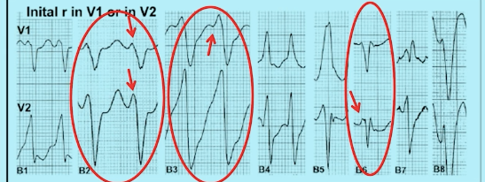 v1 或 v2 导联 qrs 波呈类左束支阻滞:起始 r 波时限 ></p></a> 40 ms1.