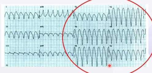 室速與室上速如何快速鑑別牢記這7項心電圖指標