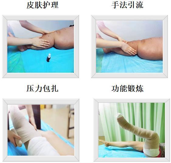 怀化市肿瘤医院在怀化市率先开展淋巴水肿综合消肿治疗(cdt)新技术