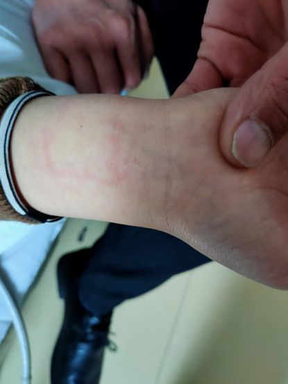 敏体质,昨天护士为期佩戴过腕带后,大约过了半个小时,患者手腕处就密