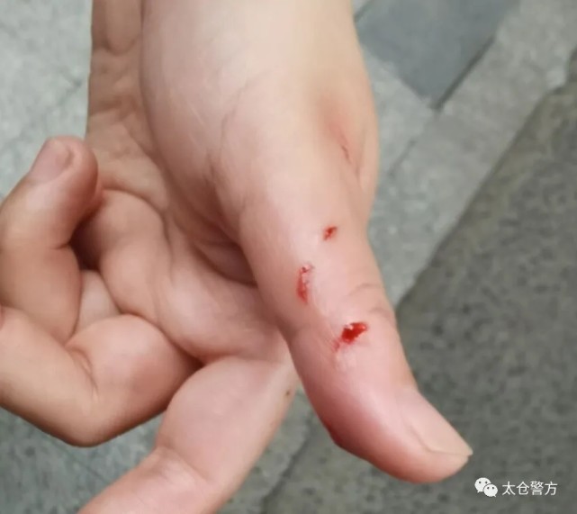 太仓市民牵狗散步,突然窜出一只金毛犬,结果被咬伤左手大拇指