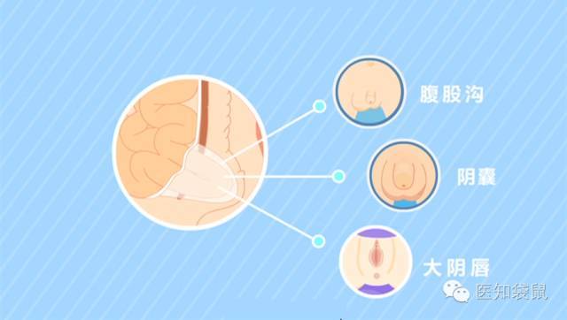 疝氣長大就好了別大意有娃因它失去卵巢蛋蛋