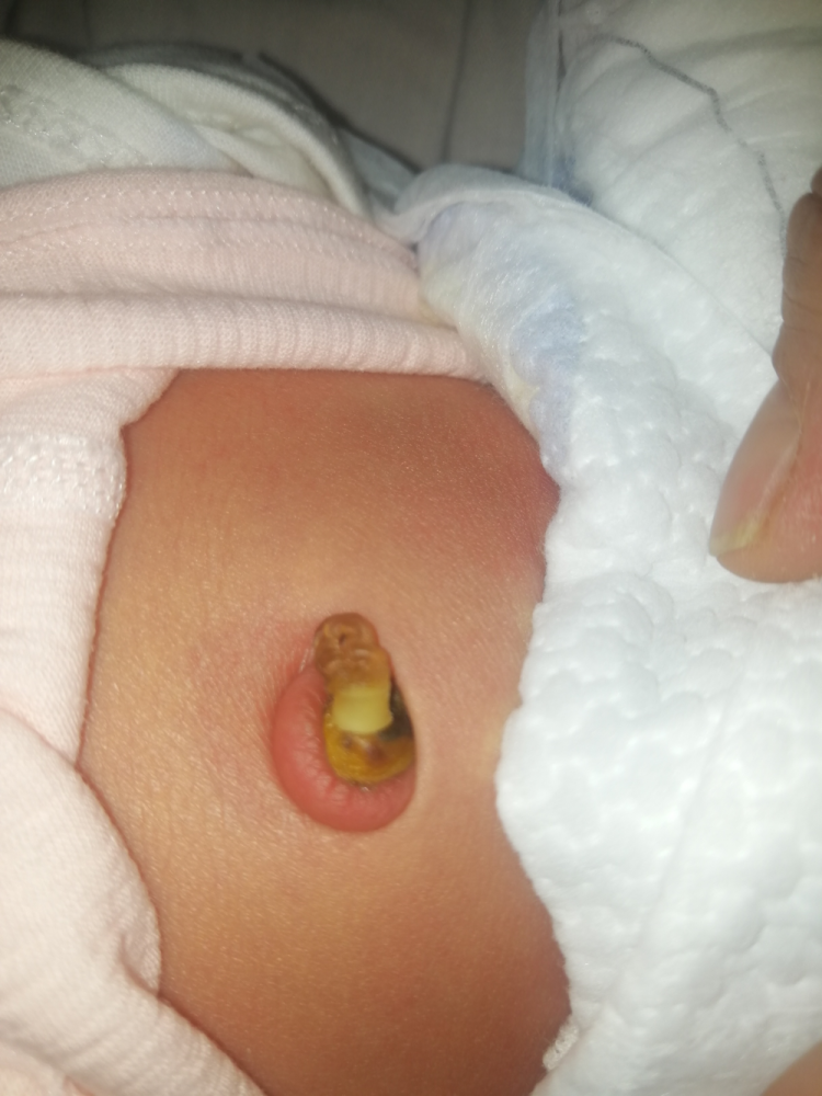 榆阳区妇幼保健院产房新技术——新生儿无包扎脐部的护理