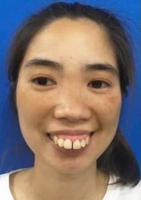 30岁女孩长得太丑无人敢追,做完整容手术美若天仙