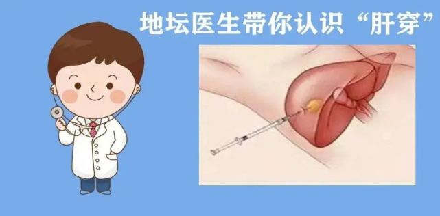 肝脏穿刺|乙肝|北京地坛医院|肝脏