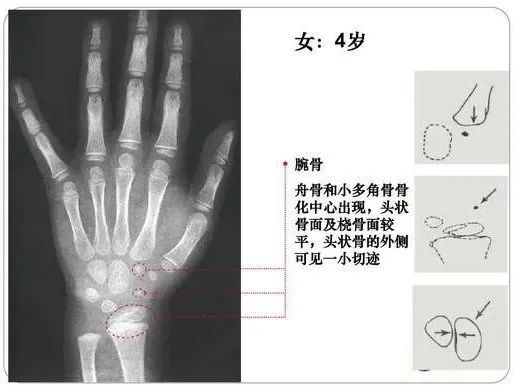 儿童手部骨骼发育图图片