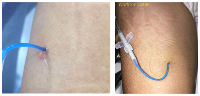 处理方法:如果并发 picc 淋巴漏液,穿刺点局部可以用藻酸盐敷料,明胶