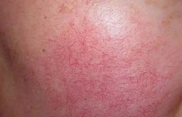 红血丝皮肤如何护理与保养