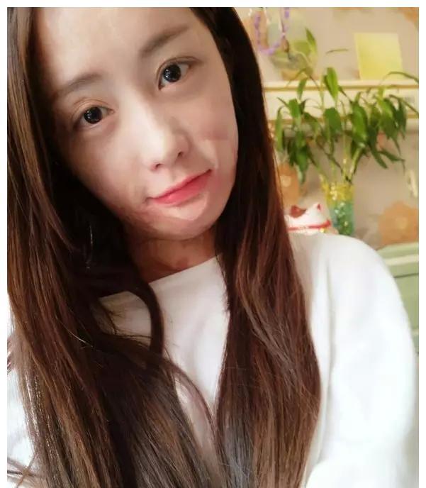 2011年,16岁少女周岩,因拒官二代追求被毁容,时隔多年还好吗?