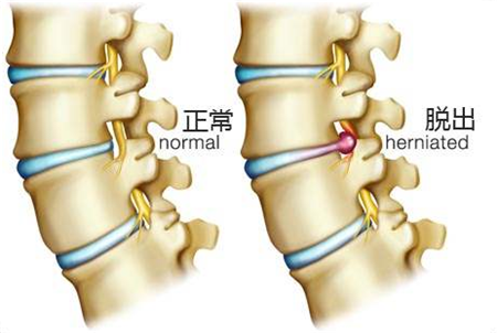 腰椎間盤突出的症狀: 1,引發坐骨神經痛.