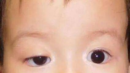 性青光眼2,光照反应方法:检查者将手电灯快速移至婴儿眼前照亮瞳孔区