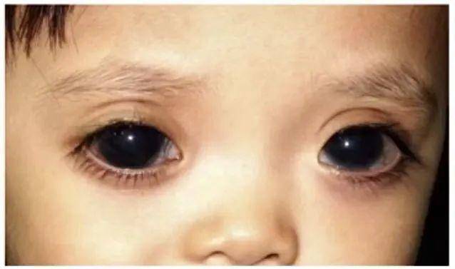 先天性青光眼2,光照反应方法:检查者将手电灯快速移至婴儿眼前照亮
