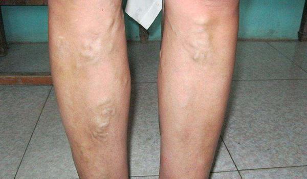 为什么有些人手背上的青筋很粗?有些人却看不到?哪种情况更好?