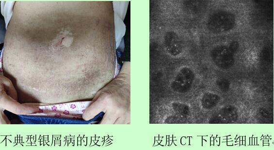 史同新主任认为患者患银屑病的可能性大,推荐患者进一步做皮肤ct检查