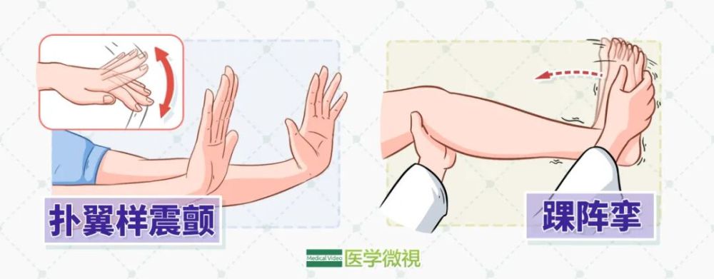 肝病患者注意出现欣快感算数难易转向儿要警惕