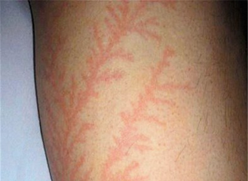 被雷劈后身上出现恐怖闪电疤痕这可比哈利波特的酷多了