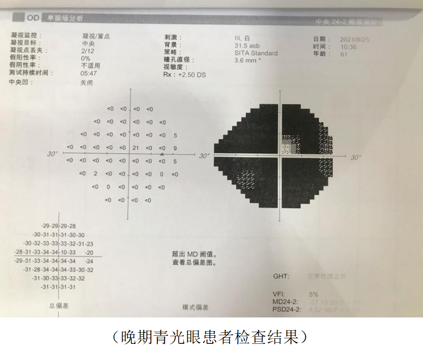 0,但周边视野大部分丢失,形成了管状视野.