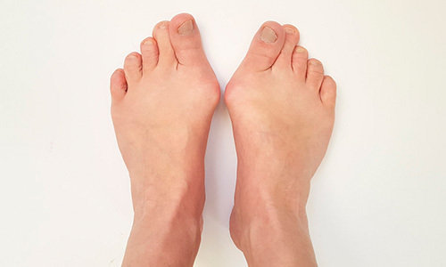 年纪大了走路脚疼拇外翻矫正的最佳年龄是多少