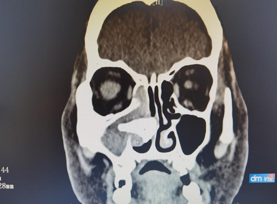 结合病理结果,确诊为鼻石合并真菌感染.