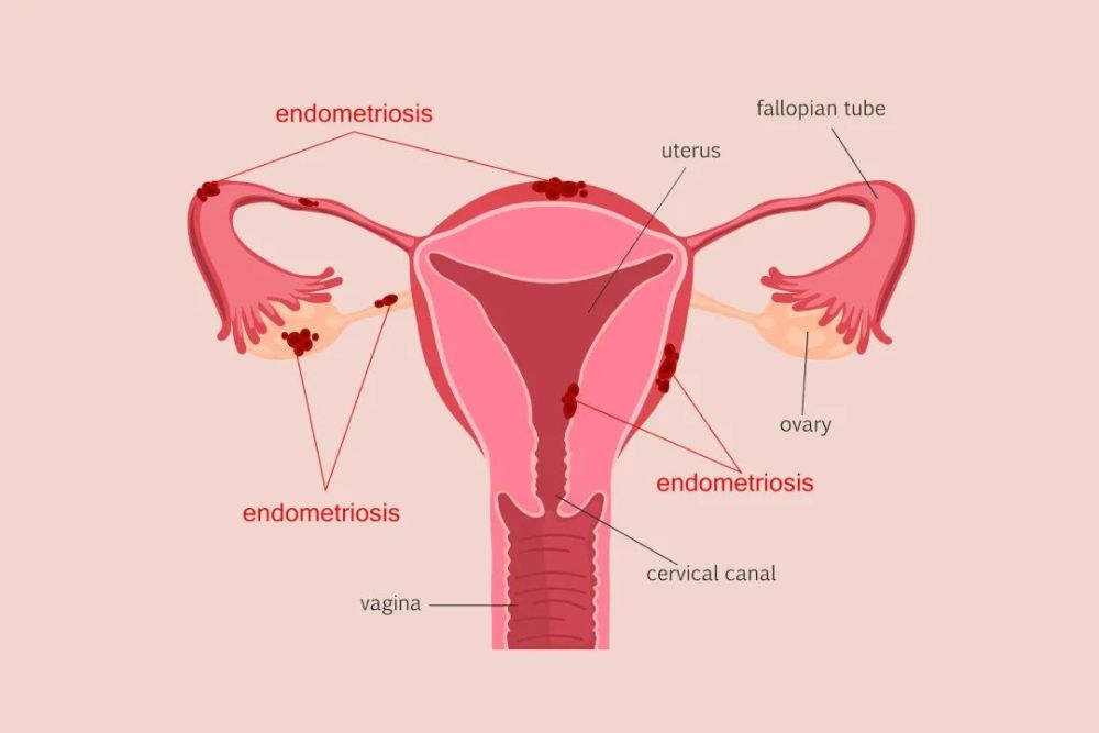 活检,有助于发现较小的或较早期的病变,减少了对子宫内膜癌的漏诊率
