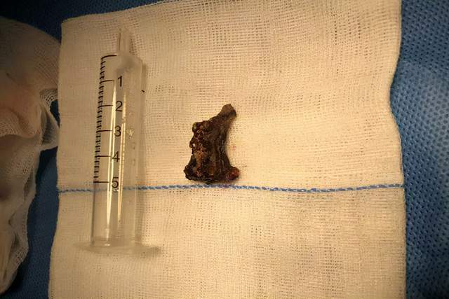 七旬老太常年鼻塞流涕,近期突然"血涕",元凶竟是它_腾讯新闻