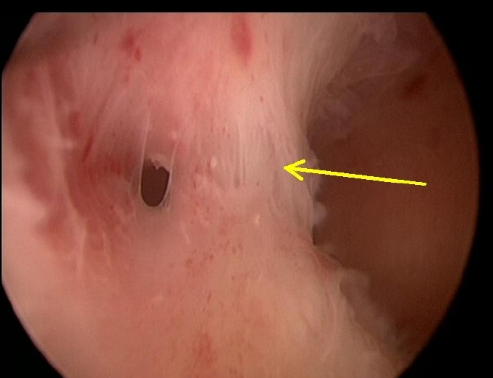 5,宫腔镜手术是诊断宫腔黏连的金标准.