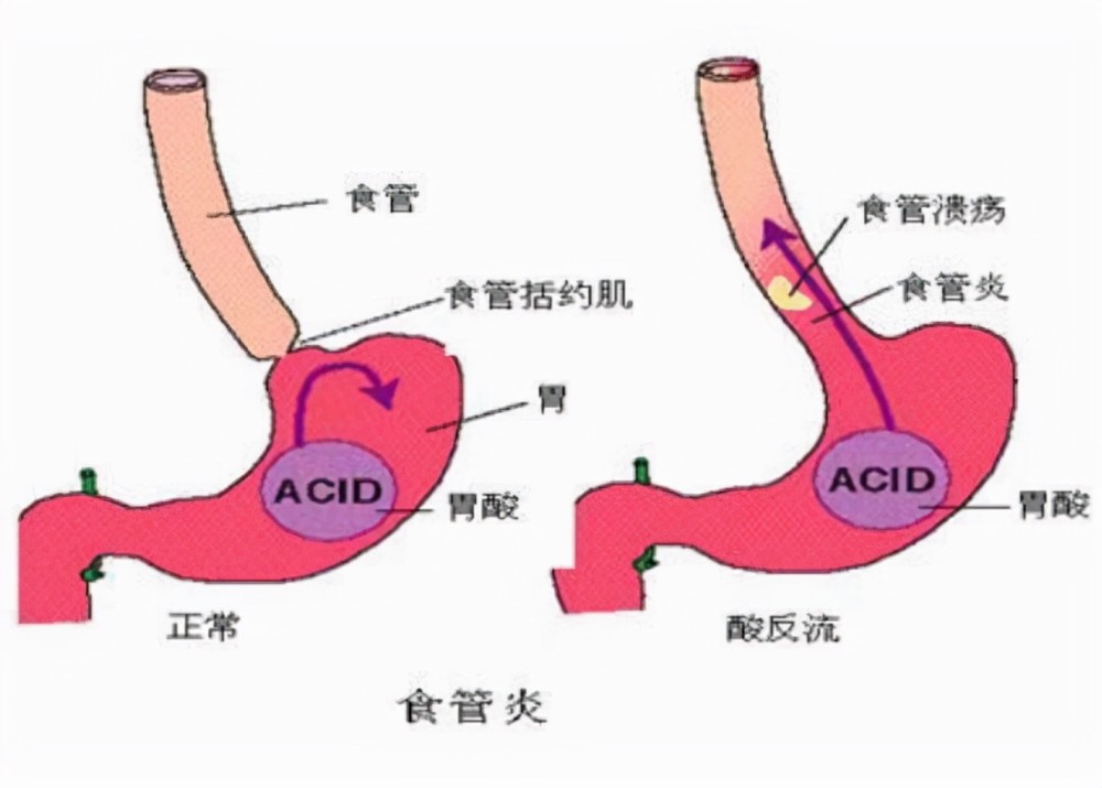 胃食道反流 腾讯网