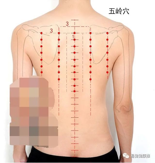 中醫針灸感冒上呼吸道感染疾病處方1